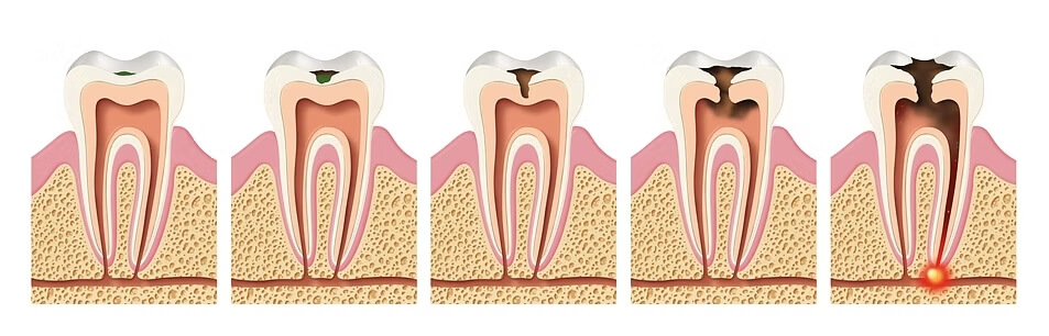 Fases de una caries dental Fases de una caries dental