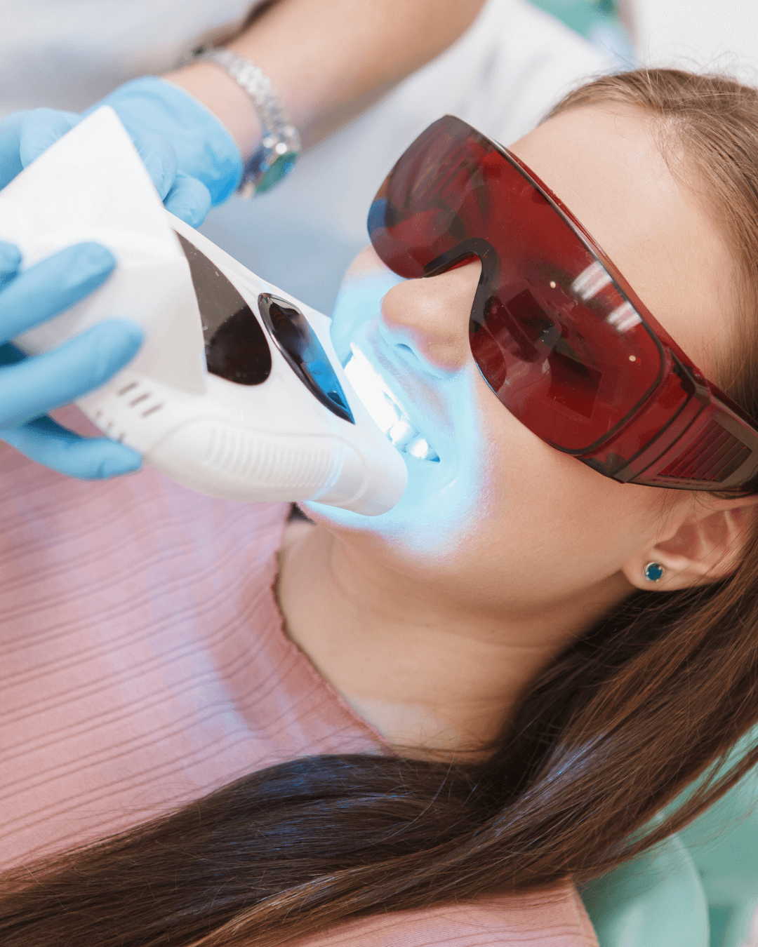 Clinica dental adame y espiga Blanqueamiento dental 02