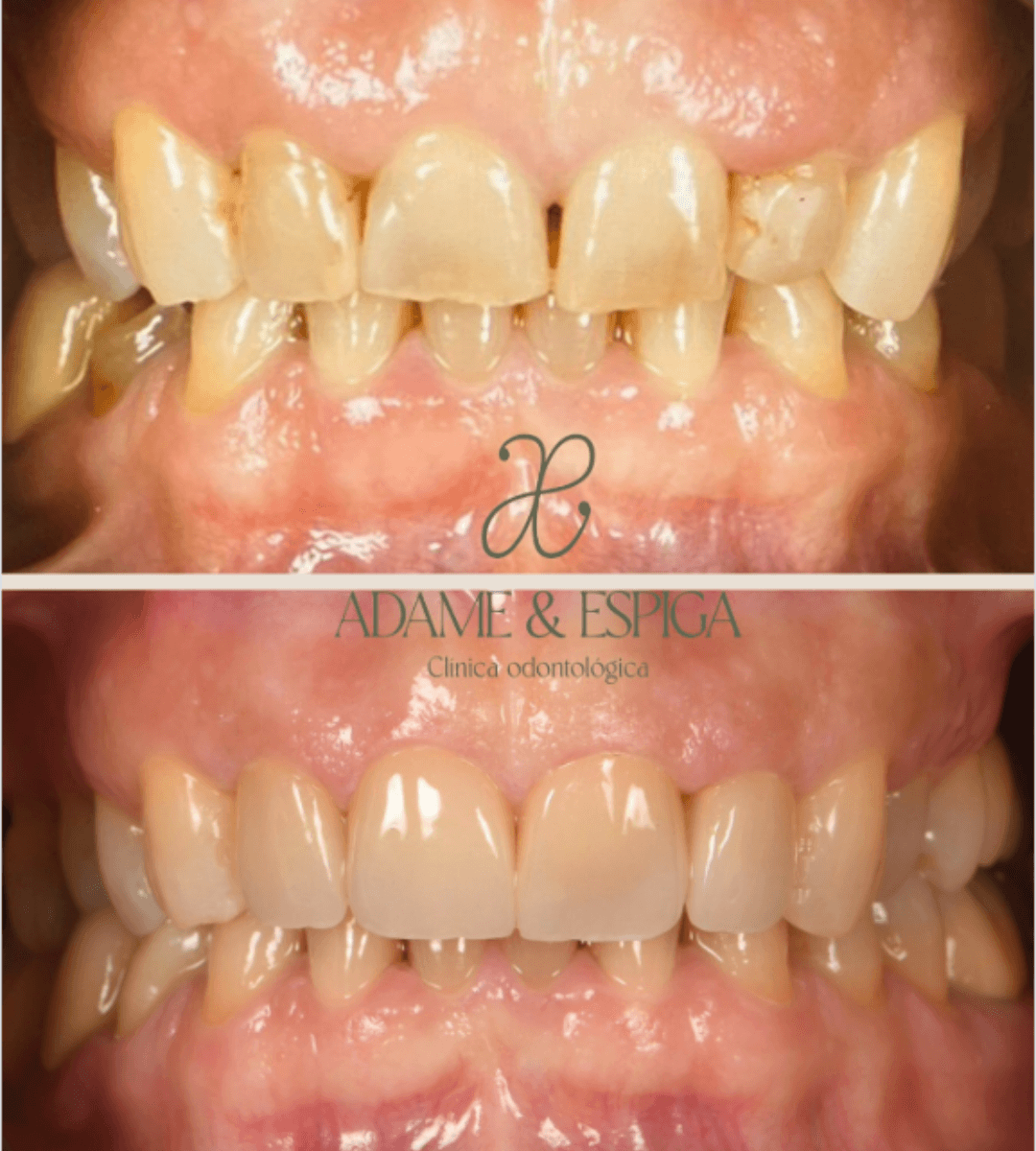 Resultado del antes y después de colocar carillas sin tallar el diente