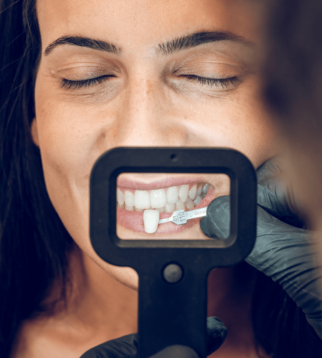 Primer plano de una sonrisa con carillas de porcelana de alta durabilidad y resistencia a manchas