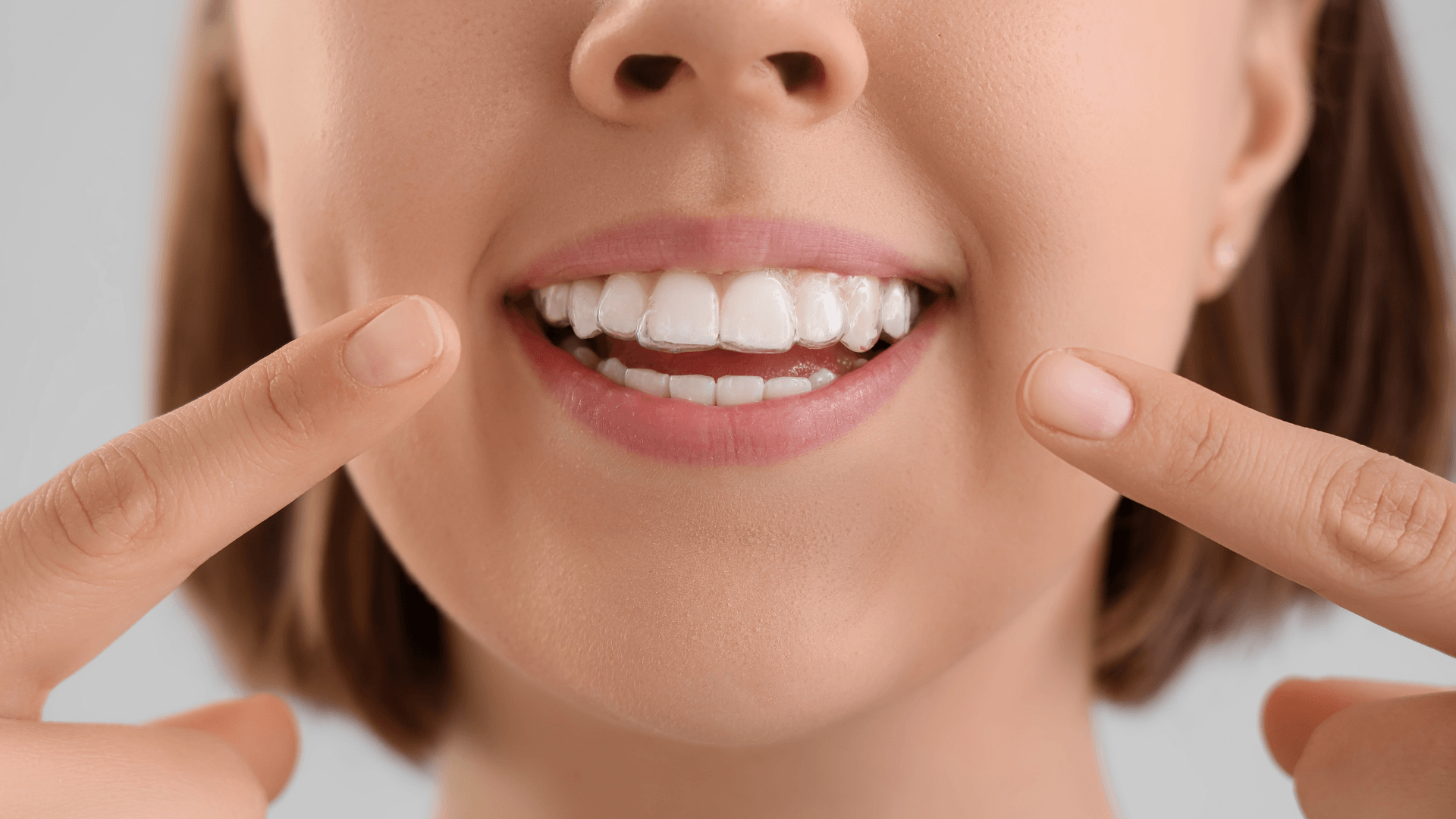 Primer plano de la sonrisa de una paciente adulta joven en Rivas, mostrando sus alineadores transparentes de ortodoncia invisible en ambas arcadas y señalándolos con los dedos de ambas manos para resaltar su discreción.