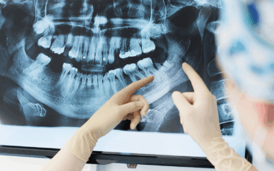 Cirugía guiada de implantes en Rivas: más precisión para recuperar tu sonrisa