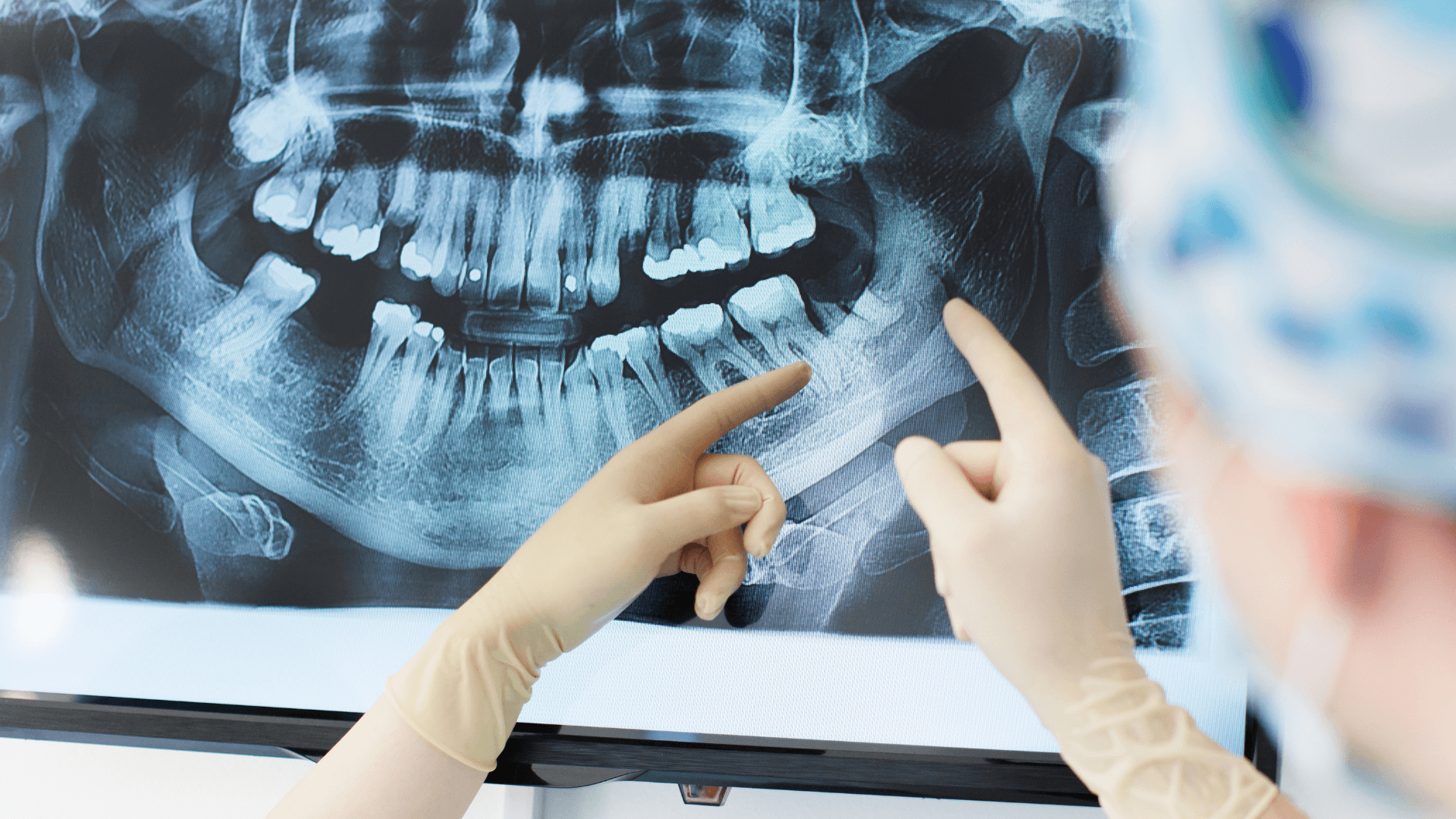 Doctores planificando una cirugía guiada de implantes en Rivas con radiografía dental