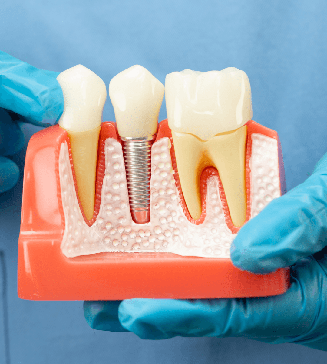Modelo dental con implante para explicar la cirugía guiada de implantes en Rivas