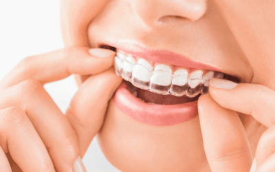 Invisalign en Rivas: qué debes saber antes de empezar un tratamiento