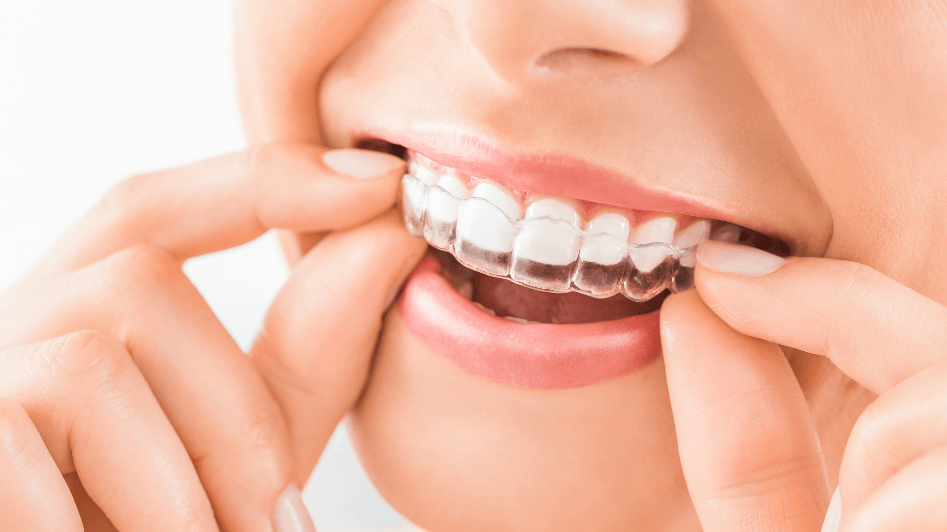 Paciente colocándose alineadores transparentes de Invisalign en Rivas