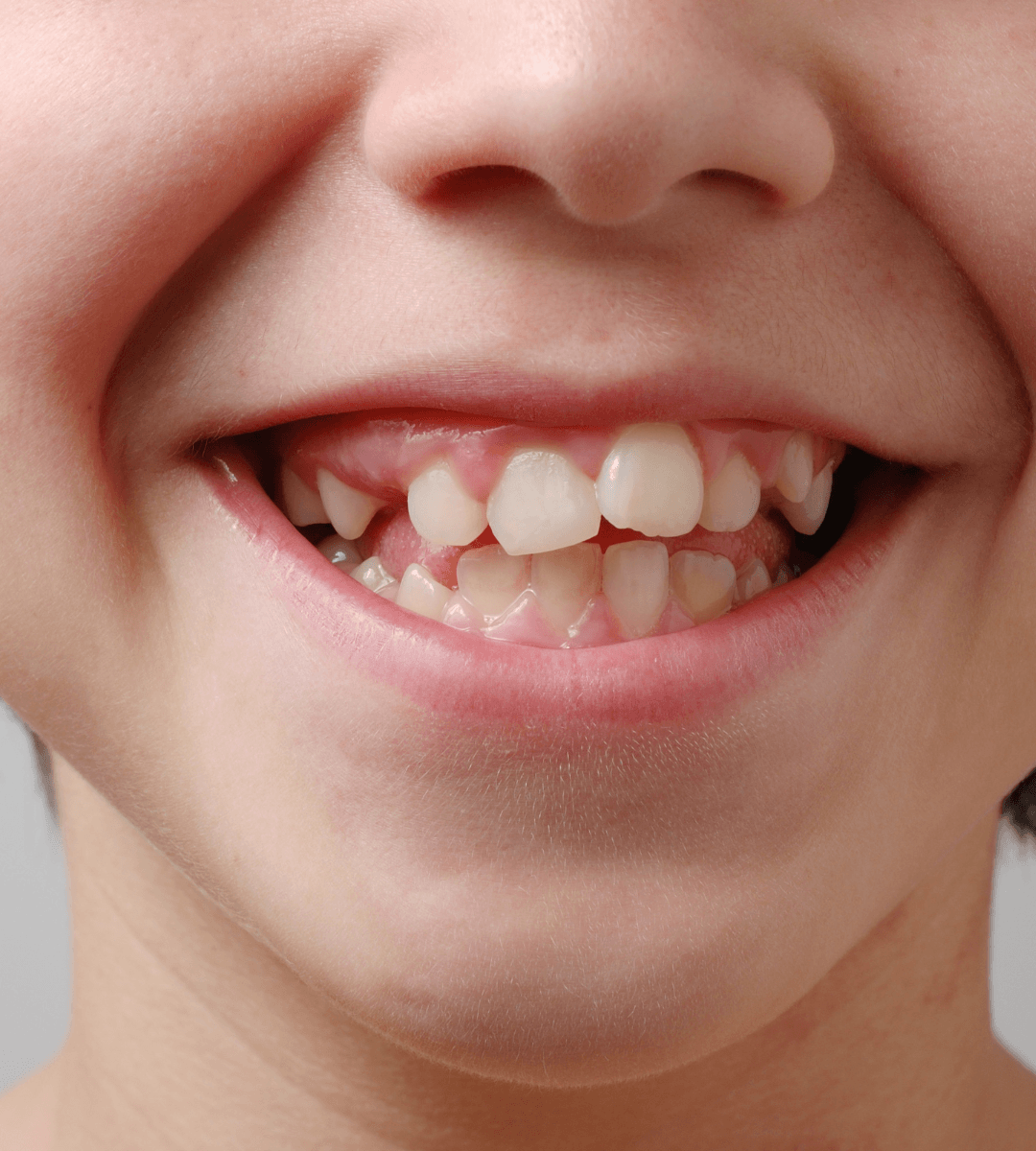 Primer plano de la sonrisa de un niño durante el recambio dental
